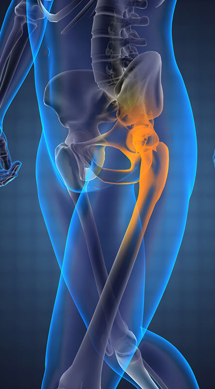 The Procedure of Hip Replacement Surgery