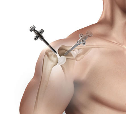 Types of Shoulder Replacement Surgery