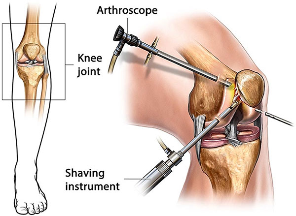 Joint Replacement Surgery in India